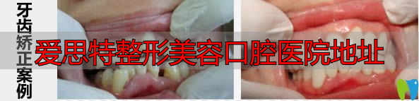 长沙爱思特口腔成人牙齿矫正案例