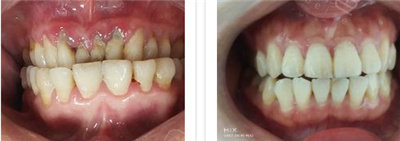 梅州围龙屋口腔门诊部正畸