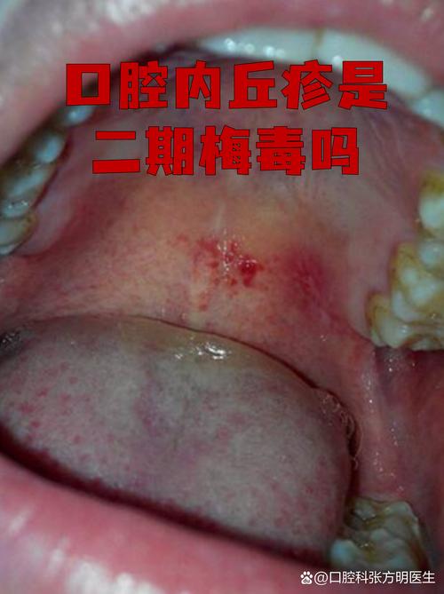 南宁治疗梅毒医院排名_南宁口腔医院排名_南宁梅毒专科医院推荐